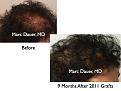 Click image for larger version

Name:	Hair Transplant Slides7.359.jpg
Views:	280
Size:	72.8 KB
ID:	469874