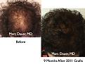Click image for larger version

Name:	Hair Transplant Slides7.360.jpg
Views:	300
Size:	83.3 KB
ID:	469875