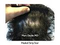 Click image for larger version

Name:	Hair Transplant Slides7.361.jpg
Views:	287
Size:	92.3 KB
ID:	469876