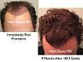 Click image for larger version

Name:	Hair Transplant Slides1.365.jpg
Views:	360
Size:	87.4 KB
ID:	469967