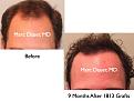 Click image for larger version

Name:	Hair Transplant Slides.362.jpg
Views:	349
Size:	61.1 KB
ID:	469968