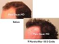 Click image for larger version

Name:	Hair Transplant Slides.363.jpg
Views:	328
Size:	61.6 KB
ID:	469969