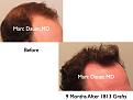 Click image for larger version

Name:	Hair Transplant Slides.364.jpg
Views:	255
Size:	57.9 KB
ID:	469970