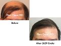 Click image for larger version

Name:	Hair Transplant Slides1.369.jpg
Views:	390
Size:	60.1 KB
ID:	469987