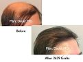 Click image for larger version

Name:	Hair Transplant Slides1.371.jpg
Views:	360
Size:	64.6 KB
ID:	469989