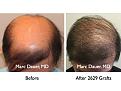 Click image for larger version

Name:	Hair Transplant Slides1.372.jpg
Views:	415
Size:	81.5 KB
ID:	469990
