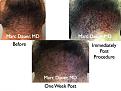 Click image for larger version

Name:	Hair Transplant Slides2.374.jpg
Views:	552
Size:	90.6 KB
ID:	470012