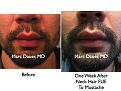 Click image for larger version

Name:	Hair Transplant Slides2.375.jpg
Views:	3869
Size:	85.5 KB
ID:	470013