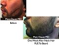 Click image for larger version

Name:	Hair Transplant Slides2.376.jpg
Views:	609
Size:	74.2 KB
ID:	470014
