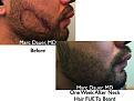 Click image for larger version

Name:	Hair Transplant Slides2.377.jpg
Views:	2122
Size:	75.3 KB
ID:	470015