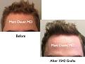 Click image for larger version

Name:	Hair Transplant Slides5.381.jpg
Views:	405
Size:	60.9 KB
ID:	470045