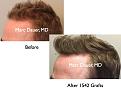 Click image for larger version

Name:	Hair Transplant Slides5.382.jpg
Views:	402
Size:	63.5 KB
ID:	470047