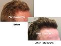 Click image for larger version

Name:	Hair Transplant Slides5.383.jpg
Views:	416
Size:	63.0 KB
ID:	470048