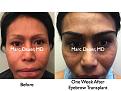 Click image for larger version

Name:	Hair Transplant Slides8.378.jpg
Views:	712
Size:	83.0 KB
ID:	470054