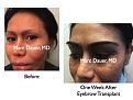 Click image for larger version

Name:	Hair Transplant Slides8.379.jpg
Views:	1786
Size:	70.0 KB
ID:	470055