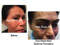 Click image for larger version

Name:	Hair Transplant Slides8.380.jpg
Views:	1011
Size:	74.6 KB
ID:	470056