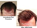 Click image for larger version

Name:	Hair Transplant Slides3.385.jpg
Views:	432
Size:	78.1 KB
ID:	470078