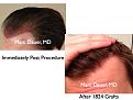 Click image for larger version

Name:	Hair Transplant Slides3.386.jpg
Views:	384
Size:	70.1 KB
ID:	470079