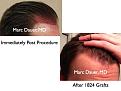 Click image for larger version

Name:	Hair Transplant Slides3.387.jpg
Views:	383
Size:	66.3 KB
ID:	470080