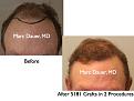 Click image for larger version

Name:	Hair Transplant Slides2.392.jpg
Views:	593
Size:	59.5 KB
ID:	470089