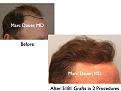 Click image for larger version

Name:	Hair Transplant Slides2.394.jpg
Views:	564
Size:	62.9 KB
ID:	470090