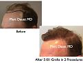 Click image for larger version

Name:	Hair Transplant Slides2.393.jpg
Views:	517
Size:	58.2 KB
ID:	470091