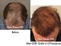 Click image for larger version

Name:	Hair Transplant Slides2.395.jpg
Views:	788
Size:	85.4 KB
ID:	470092