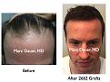 Click image for larger version

Name:	Hair Transplant Slides.400.jpg
Views:	405
Size:	69.0 KB
ID:	470138