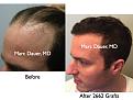 Click image for larger version

Name:	Hair Transplant Slides.401.jpg
Views:	388
Size:	68.3 KB
ID:	470139
