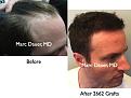 Click image for larger version

Name:	Hair Transplant Slides.402.jpg
Views:	375
Size:	70.8 KB
ID:	470140