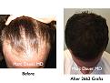 Click image for larger version

Name:	Hair Transplant Slides.403.jpg
Views:	386
Size:	79.3 KB
ID:	470141