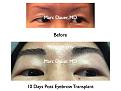 Click image for larger version

Name:	Hair Transplant Slides6.399.jpg
Views:	2521
Size:	66.2 KB
ID:	470142