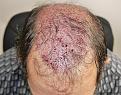 Click image for larger version

Name:	cs immediate post-op chin down.jpg
Views:	295
Size:	96.5 KB
ID:	470147
