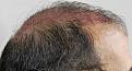 Click image for larger version

Name:	cs immediate post-op L profile.jpg
Views:	304
Size:	99.3 KB
ID:	470150