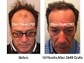 Click image for larger version

Name:	Hair Transplant Slides.424.jpg
Views:	598
Size:	82.8 KB
ID:	470209