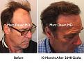 Click image for larger version

Name:	Hair Transplant Slides.426.jpg
Views:	328
Size:	91.5 KB
ID:	470211