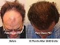 Click image for larger version

Name:	Hair Transplant Slides.427.jpg
Views:	602
Size:	91.6 KB
ID:	470212