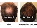 Click image for larger version

Name:	Hair Transplant Slides.428.jpg
Views:	430
Size:	77.8 KB
ID:	470213