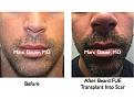 Click image for larger version

Name:	Hair Transplant Slides.422.jpg
Views:	7508
Size:	81.9 KB
ID:	470234