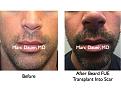 Click image for larger version

Name:	Hair Transplant Slides.422.jpg
Views:	7292
Size:	81.9 KB
ID:	470234