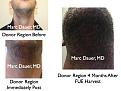 Click image for larger version

Name:	Hair Transplant Slides.423.jpg
Views:	823
Size:	81.3 KB
ID:	470235
