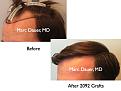 Click image for larger version

Name:	Hair Transplant Slides2.413.jpg
Views:	297
Size:	56.4 KB
ID:	470251