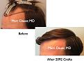 Click image for larger version

Name:	Hair Transplant Slides2.413.jpg
Views:	379
Size:	56.4 KB
ID:	470251