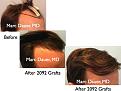 Click image for larger version

Name:	Hair Transplant Slides2.414.jpg
Views:	314
Size:	66.6 KB
ID:	470252