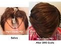 Click image for larger version

Name:	Hair Transplant Slides2.415.jpg
Views:	330
Size:	90.7 KB
ID:	470253
