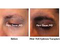 Click image for larger version

Name:	Hair Transplant Slides.439.jpg
Views:	2004
Size:	58.3 KB
ID:	470309