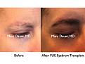 Click image for larger version

Name:	Hair Transplant Slides.440.jpg
Views:	1154
Size:	63.4 KB
ID:	470310