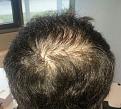 Click image for larger version

Name:	Pre op crown.jpg
Views:	449
Size:	47.0 KB
ID:	470319