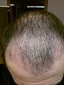 Click image for larger version

Name:	post-op 3 months result.jpg
Views:	487
Size:	53.6 KB
ID:	470321