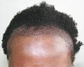 Click image for larger version

Name:	np - immediate post-op front.jpg
Views:	271
Size:	91.2 KB
ID:	470328